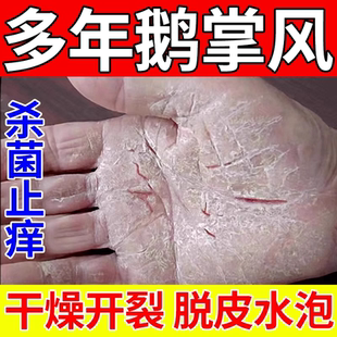 华佗膏治疗鹅掌风专用药膏正品手癣膏脱皮干裂真菌感染止痒用