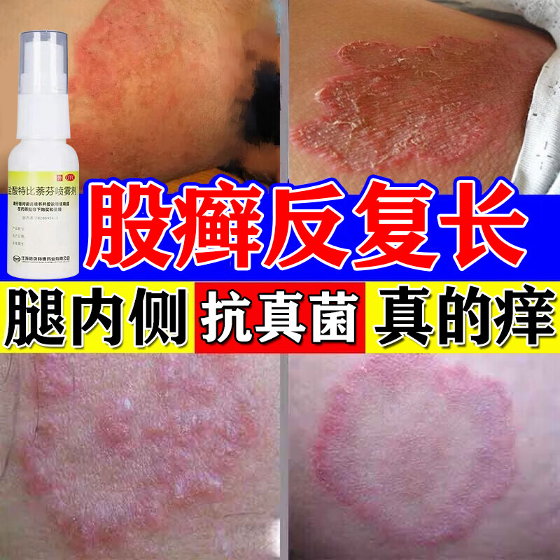 股癣藓专用药膏瘙痒大腿内侧真菌感染牛皮癣抑菌去廯皮肤体癣止痒