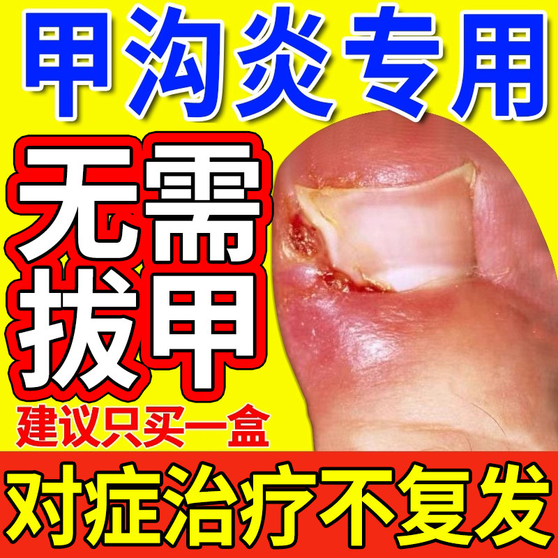 甲沟炎治疗专用特药膏效脚指甲长肉里消肿去肉芽息肉嵌甲消炎药膏