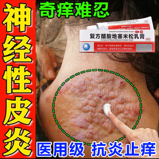 神经性皮炎专用药顽固瘙痒止痒过敏药膏湿疹皮癣真菌感染皮肤用药