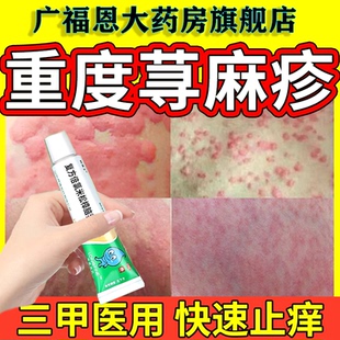 治疗寻荨麻疹过敏皮肤瘙痒止痒湿疹神经性皮炎抑菌抗过敏专用药膏