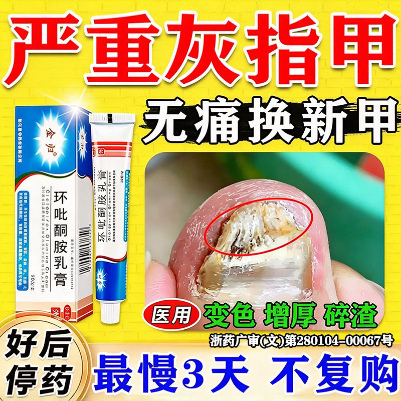 治疗重度灰指甲的药膏指甲增厚发黄变厚真菌感染皮肤用药