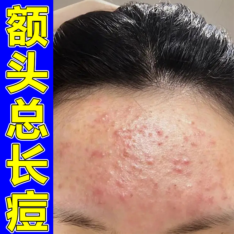 青春痘外用膏男女学生青少年额头长上长痘闭口粉刺去豆豆正品