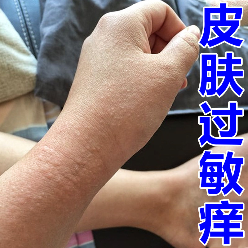 手腕胳膊痒手背上起小红点颗粒疙瘩痒外用修复霜
