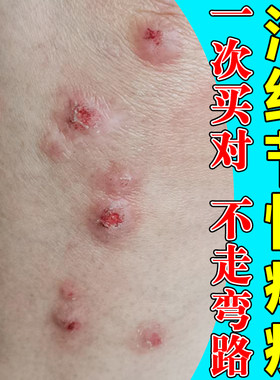 身上痒长顽固硬疙瘩全身皮肤红点用