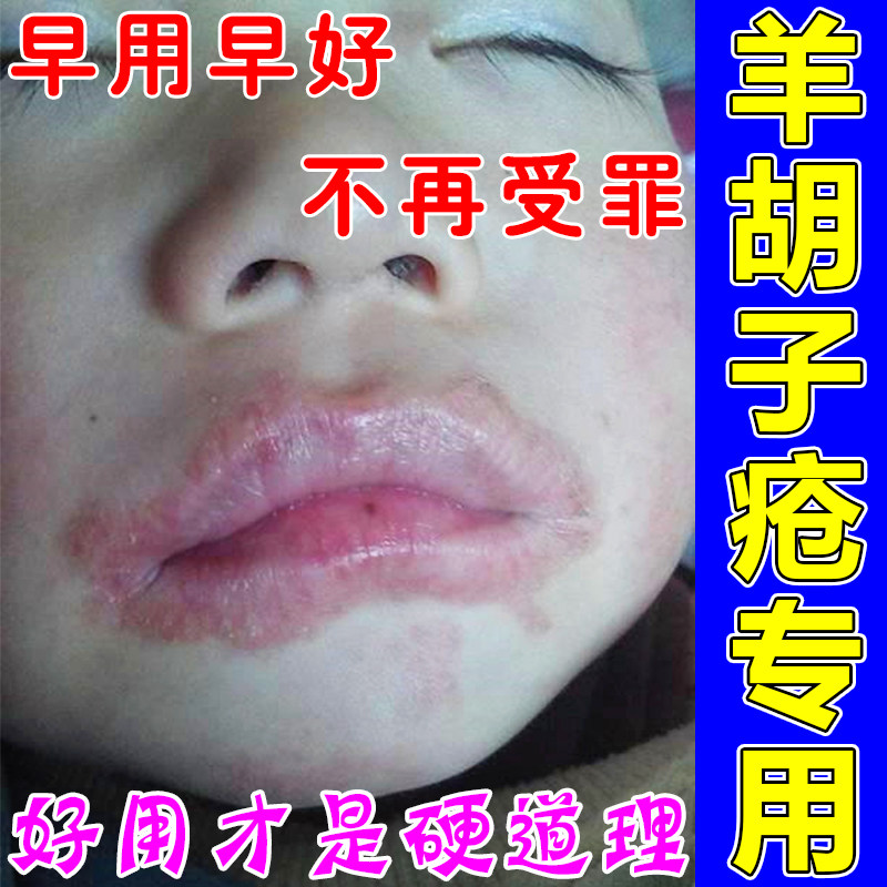 唇炎专用唇膏防止儿童舔嘴唇干裂脱皮起皮干痒羊胡子疮嘴唇一圈红