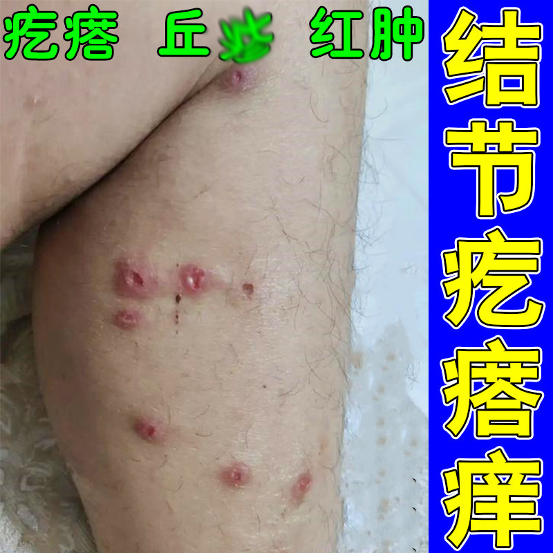 结节性痒治顽固硬疙瘩结痂全身皮肤外用