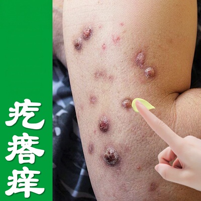 腿上起硬疙瘩皮肤粗糙干燥过敏身上痒长硬疙瘩褐色沉淀修护药乳膏