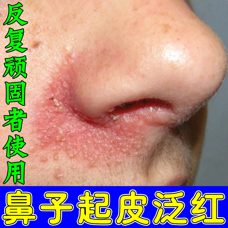 鼻子两侧发红脱皮鼻翼两边泛红干燥起皮掉皮痒油腻鼻头发红专用膏