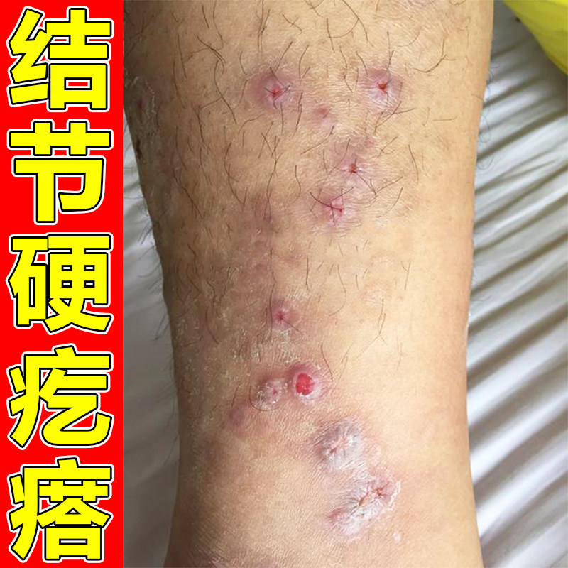 顽固硬疙瘩腿上皮肤发痒抓挠结痂用的软膏