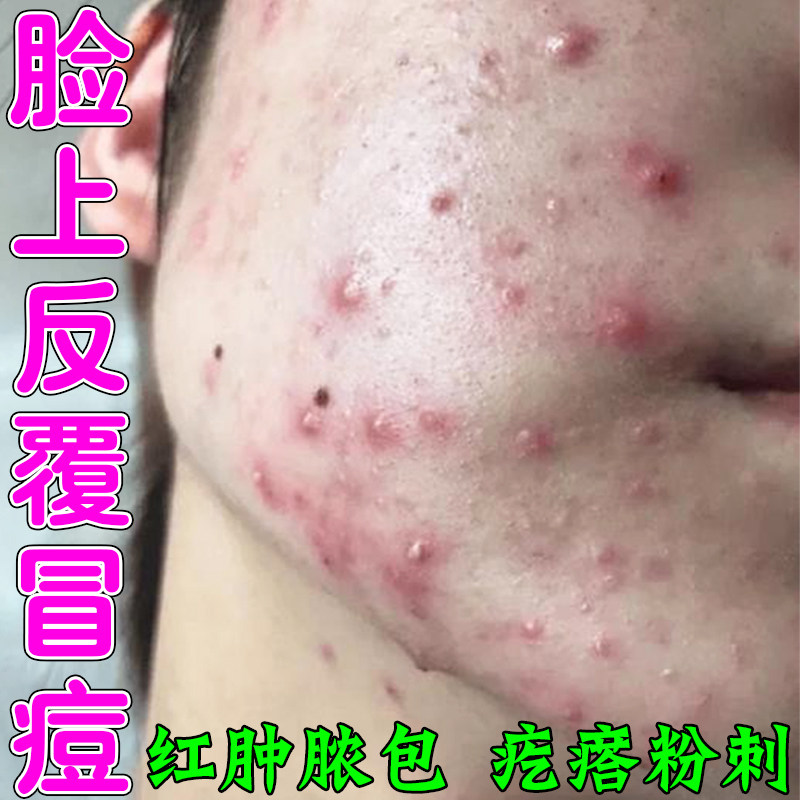 脸上反复长痘闭合性粉刺上火痘男女学生外用青春痘软膏