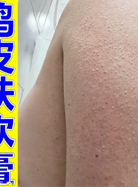 去鸡皮肤疙瘩毛囊角化膏全身手臂腿毛脸上周角化身体乳膏