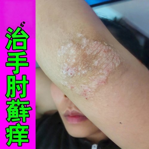 手肘皮肤痒胳膊肘长鲜神经性干燥起皮粗糙顽固性皮鲜痒膏