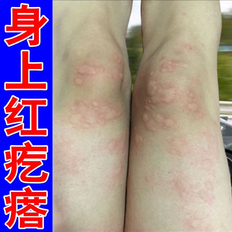 身上起风团性荨麻诊湿风疙瘩抓痕皮肤消毒护理（消）