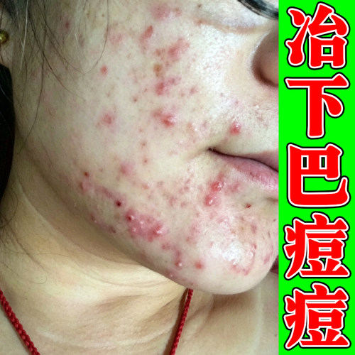 下巴长痘口周冒包下颌硬块凸起熬夜经期出油堆积脸上额头长痘痘