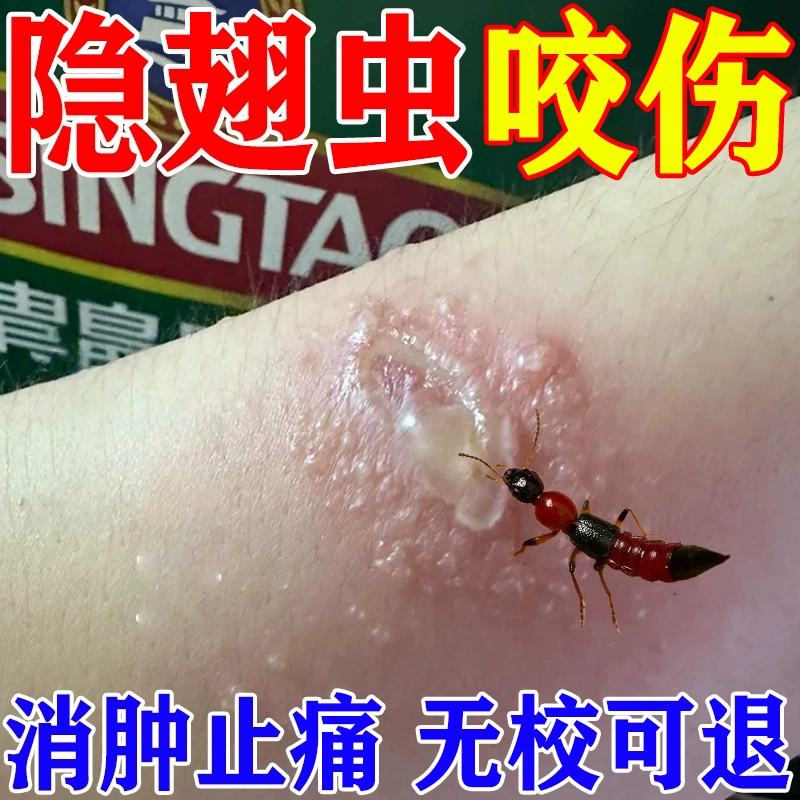 隐翅虫软膏皮治红蚂蚁臭虫咬伤水疱脓包糜烂痒烧灼疼痛蚊虫膏