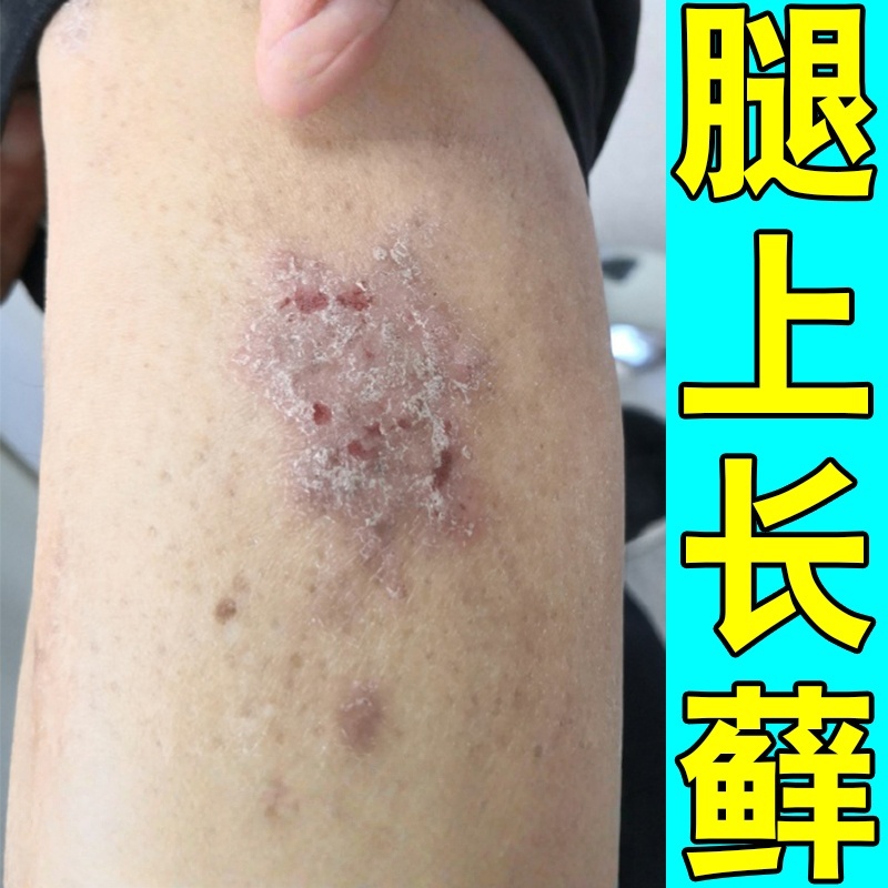 腿上长鲜腿部发痒小腿干燥起皮掉皮屑治顽固皮肤鲜过敏起疙瘩疹子