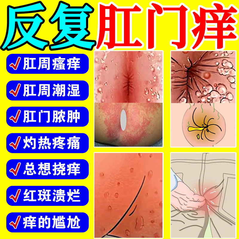 肛门瘙痒用什么男女性屁眼痒肛周潮湿红疹开裂痔疮止痒抑菌专用膏