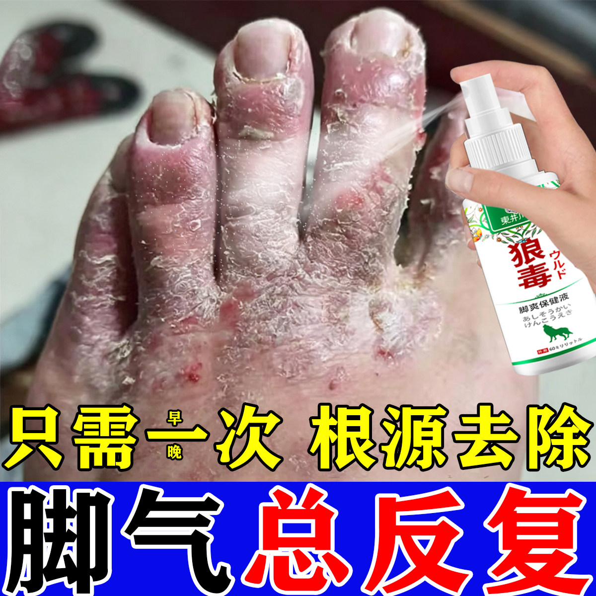 脚气止痒脱皮杀菌真菌感染专用烂脚趾脱皮糜烂脚丫脚出汗水泡脚臭