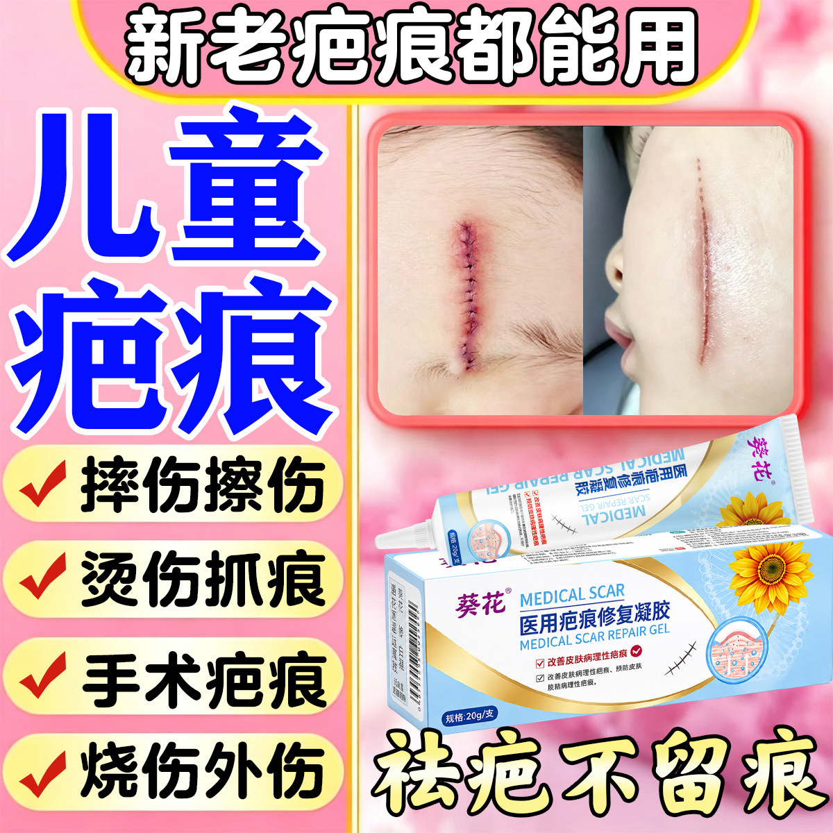祛疤膏儿童专用小孩脸部去疤痕修复除疤烫伤摔伤抓痕缝针硅酮凝胶