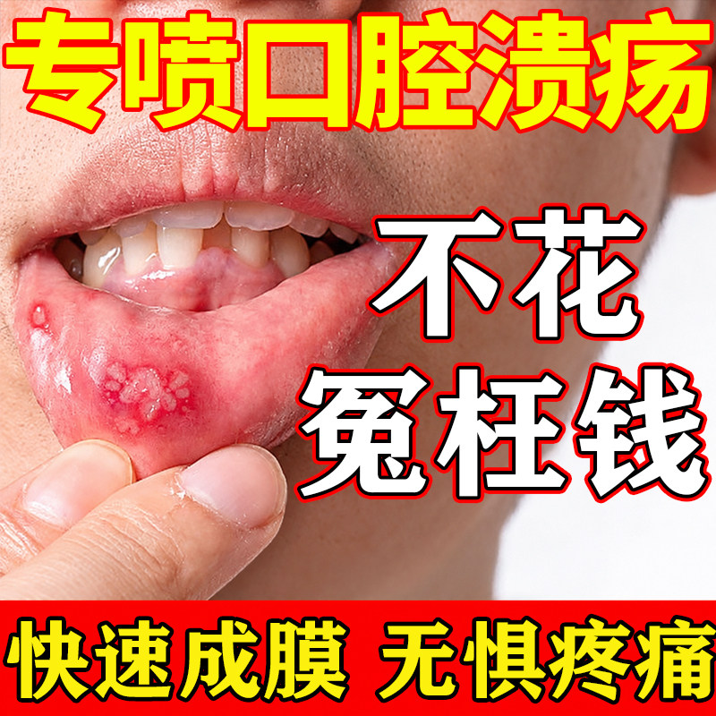 同仁堂口腔溃疡喷剂舌头溃疡嘴上火起泡口舌生疮疼痛白泡黏膜修复