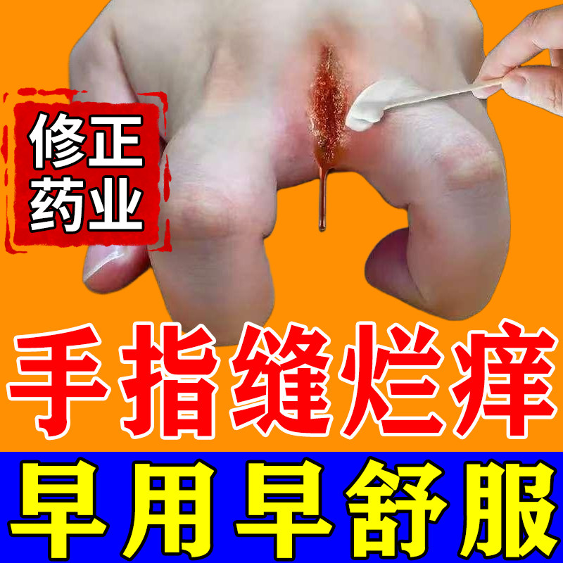 手指缝溃烂膏烂手丫手指间经常碰水瘙痒开裂发红脱皮真菌感染专用