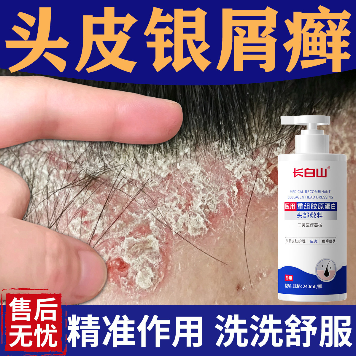 银屑病专用洗发水头脂溢性皮炎皮癣真菌感染头屑头痒头皮止痒喷剂