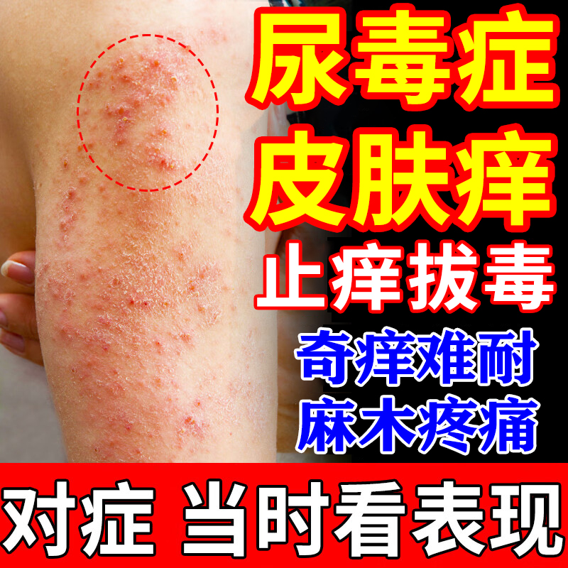 尿毒症皮肤痒血液透析后止痒膏皮肤瘙痒老年人全身干燥灼热止痒膏