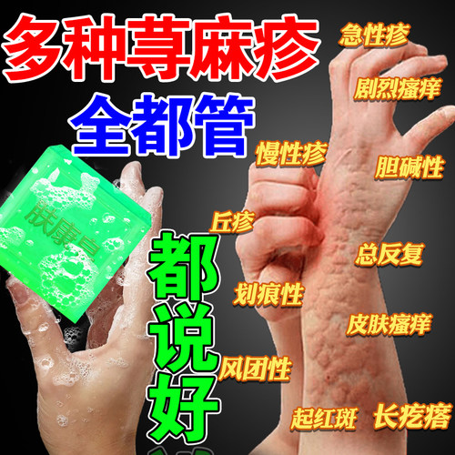 寻荨麻疹过敏专用皂皮肤痒急慢性胆碱性风团抑儿童成人抑菌香皂