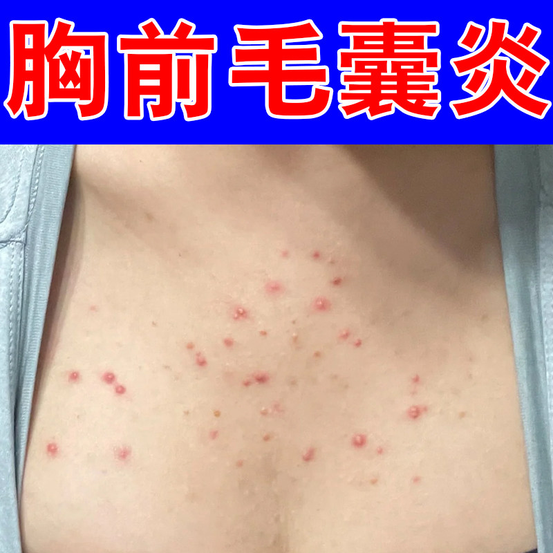 胸前毛囊炎毛孔粗大毛囊堵塞专用皮肤粗糙起痘痘疙瘩马拉色菌感染
