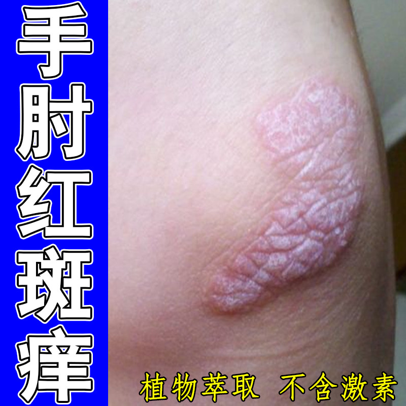 手肘红斑痒干燥起皮增厚老年人身上痒起皮粗糙红肿去黑皮硬皮专用