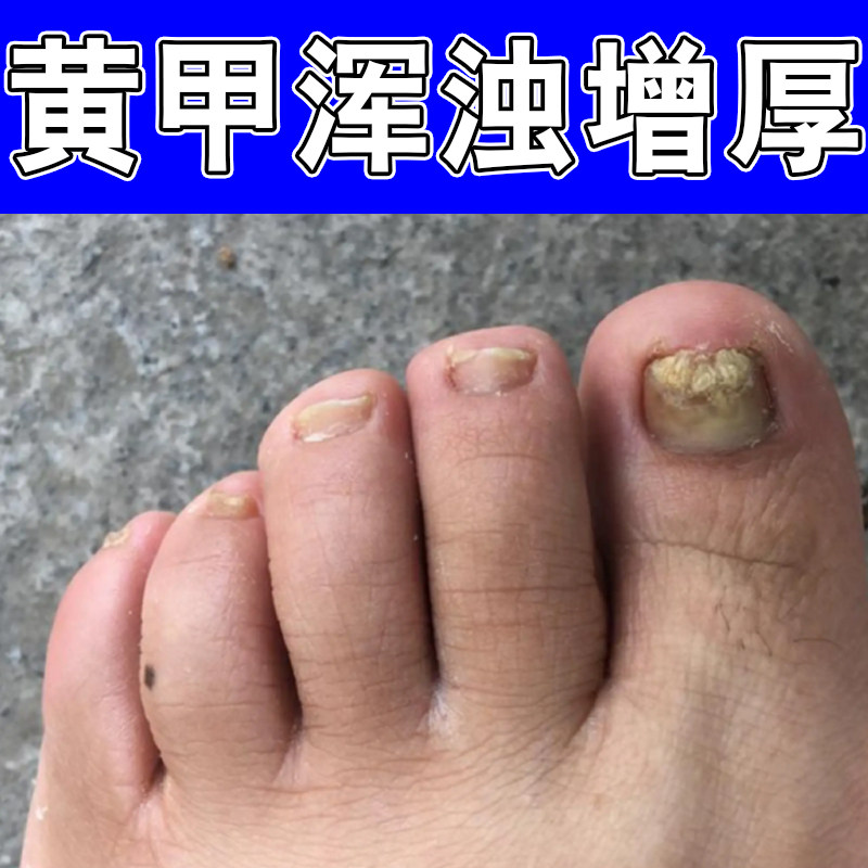 黄甲浑浊增厚冶脚趾甲变厚发黄指甲盖残缺坏甲空甲感染手指甲变色