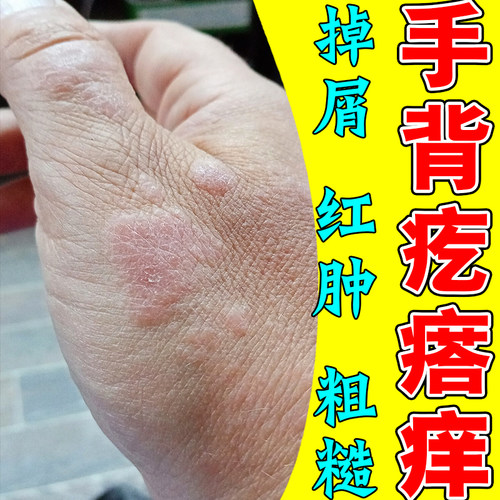 手背痒起皮屑长疙瘩脱皮干裂刺挠日光性过敏粗糙皮肤干燥痒