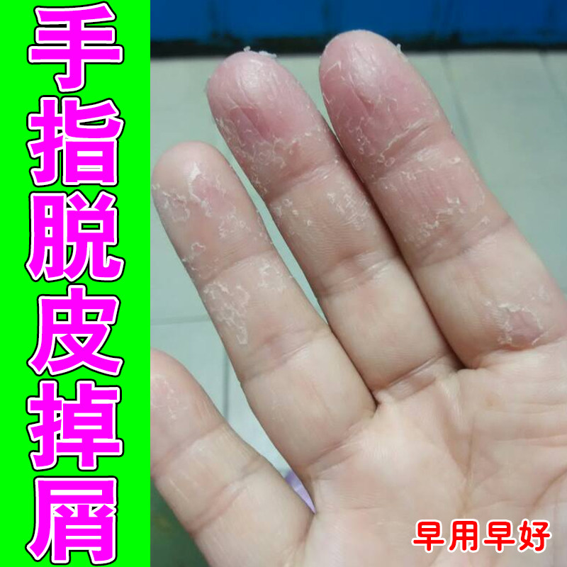 手指脱皮掉屑手上起皮干燥儿童缺乏维生素季节性过敏痒手脚开裂口