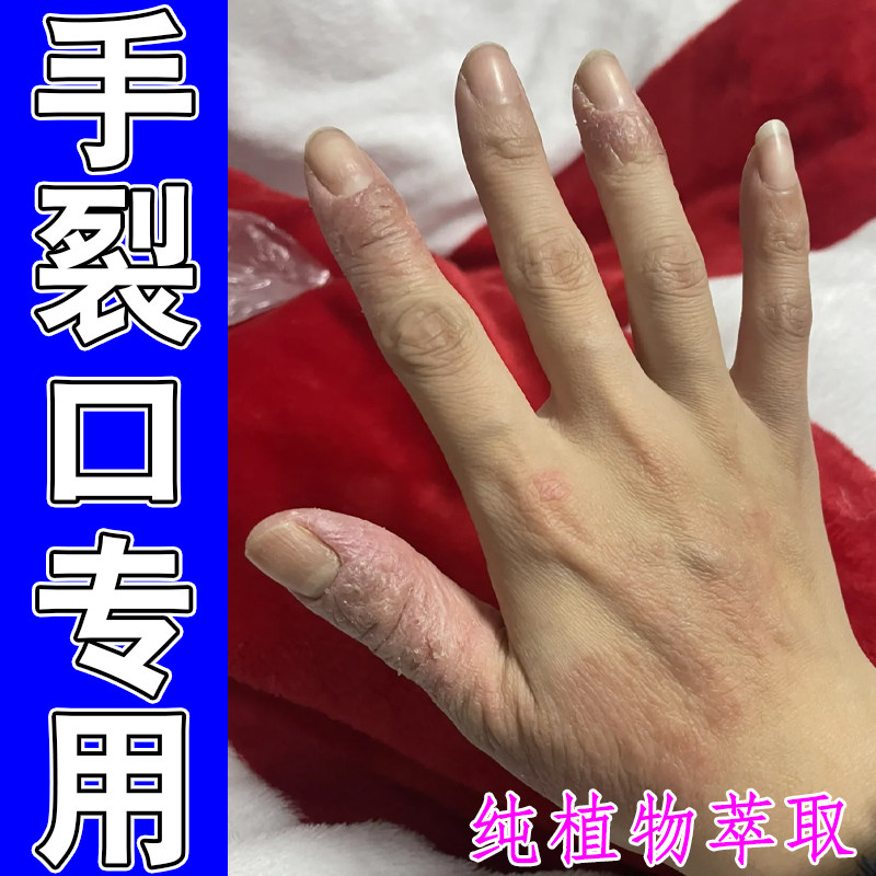 手裂口专用手脱皮角化型手指关节硬皮红肿痒掉屑皮肤干燥蜕皮粗糙