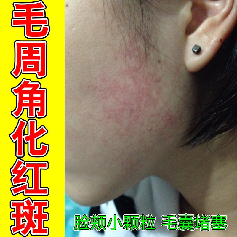 儿童脸上长逆光疹闭口鸡皮肤脸颊两边长痘毛孔粗大眼部脂肪粒修复