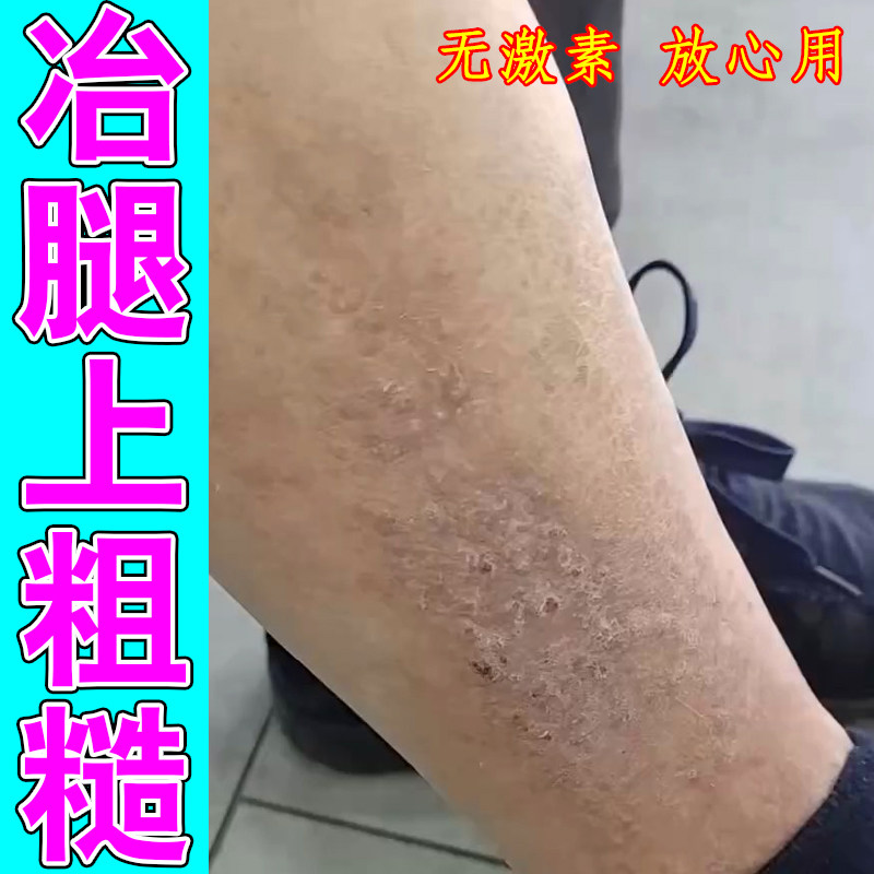 冶腿上粗糙干痒红肿起硬疙瘩褐色蛋白沉淀长小红点皮肤过敏修护药