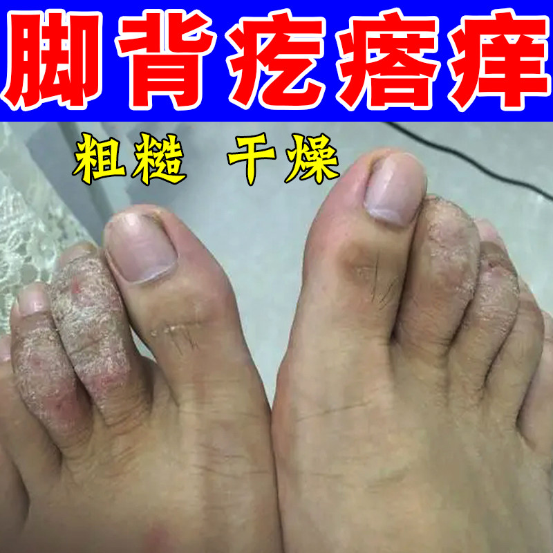 脚背疙瘩红刺挠脚趾干燥粗糙起水泡掉屑脱皮长红斑专用修复药乳膏