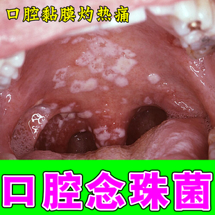 口腔黏膜修复口腔白色念珠菌赦免溃烂感染口腔上长白斑糜烂修复药