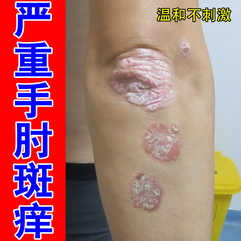 严重手肘斑痒胳膊肘干燥起皮掉屑红肿痒神经性皮肤增厚鳞屑角质痒