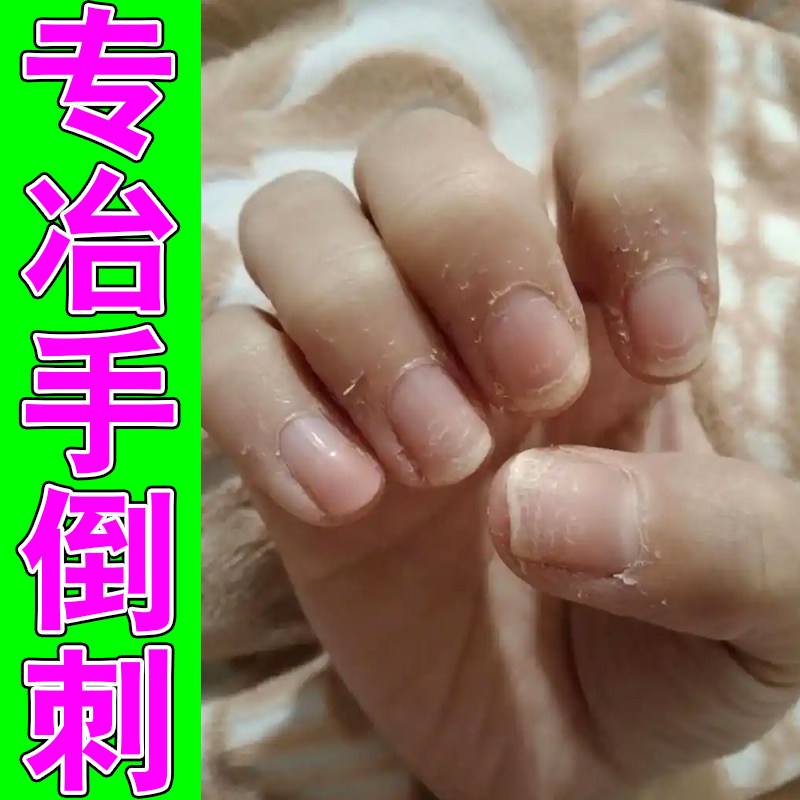 专冶手倒刺修复受损手部皮肤干燥手边缘肉刺疼专用表皮撕裂保湿药