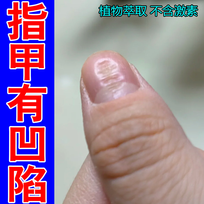 指甲有凹陷指甲分层甲分离萎缩甲指甲开裂空甲甲变黄增厚外用修护