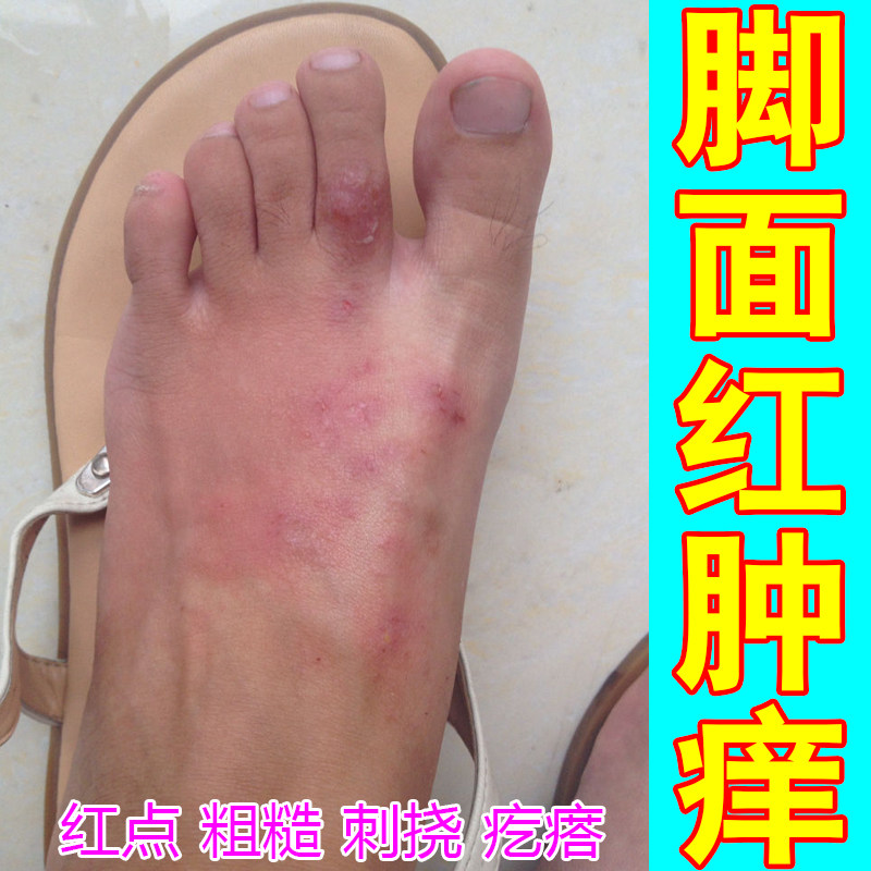 脚背红肿痒起红疙瘩红点干痒脚汗脚脚趾缝痒起小水泡