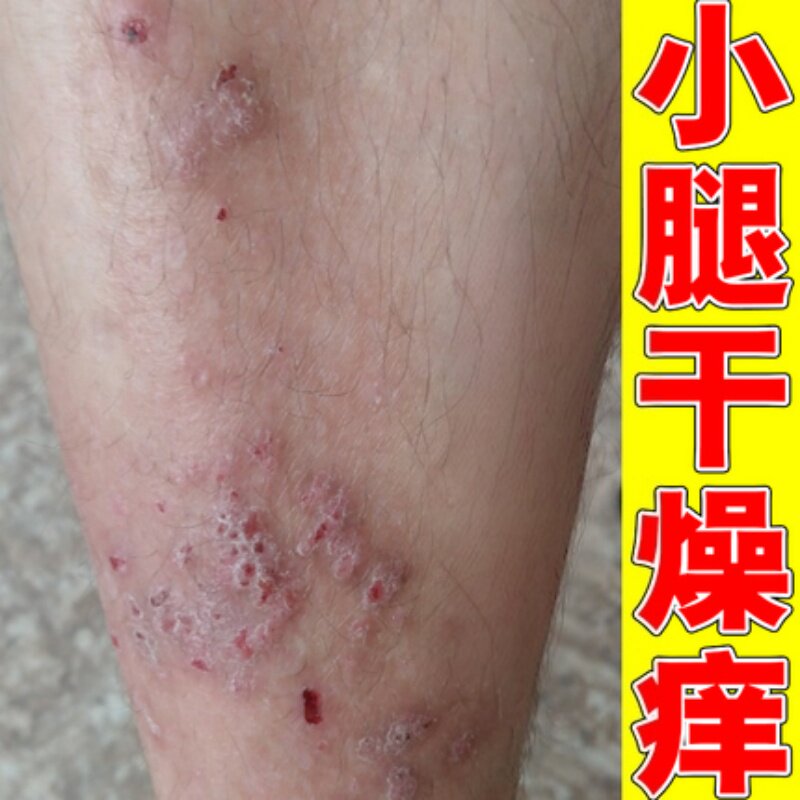 小腿痒皮肤干燥痒长红斑过敏性腿上长红疙瘩红点顽固性疹子草本膏
