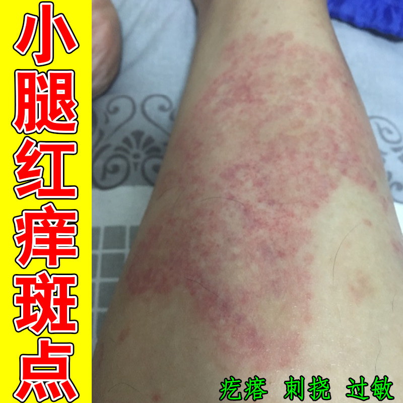 小腿红痒斑点皮肤发干起皮纹路粗糙换季发痒掉屑过敏红肿抓挠修护