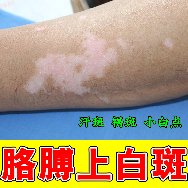 白颠风外用黑色素生长手上有白点快速消白斑补骨脂酊专用膏药