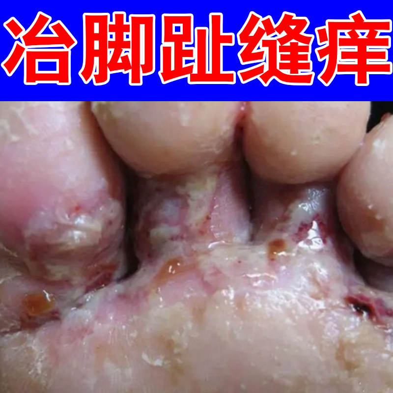 冶脚趾缝痒脚底起小水泡干燥粗糙掉屑红肿痒晚上痒的睡不着刺挠痒
