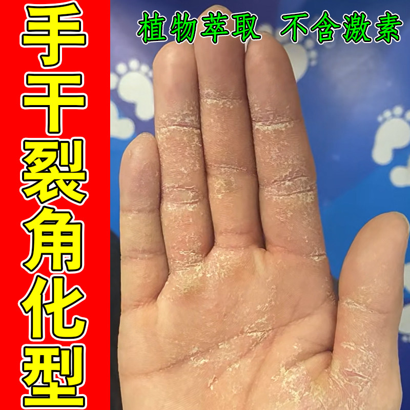 手干裂角化型粗糙干燥痒掉屑手指缝起皮鳞屑型脚后跟干裂口保湿药