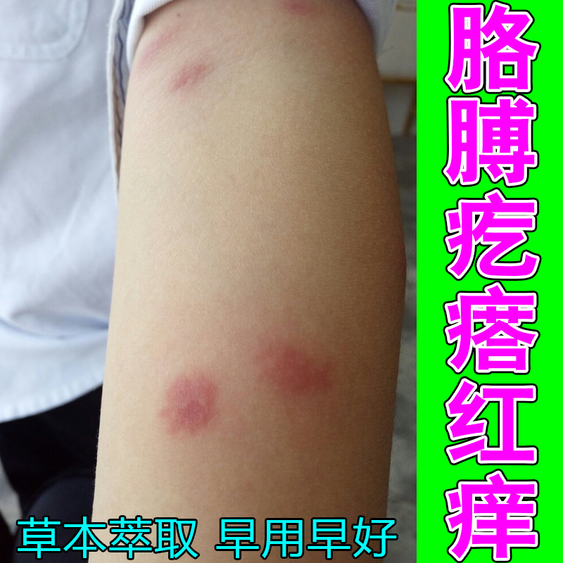 冶胳膊疙瘩红痒身上长红疙瘩痒掉屑脱皮出汗身上过敏痒顽固红肿痒