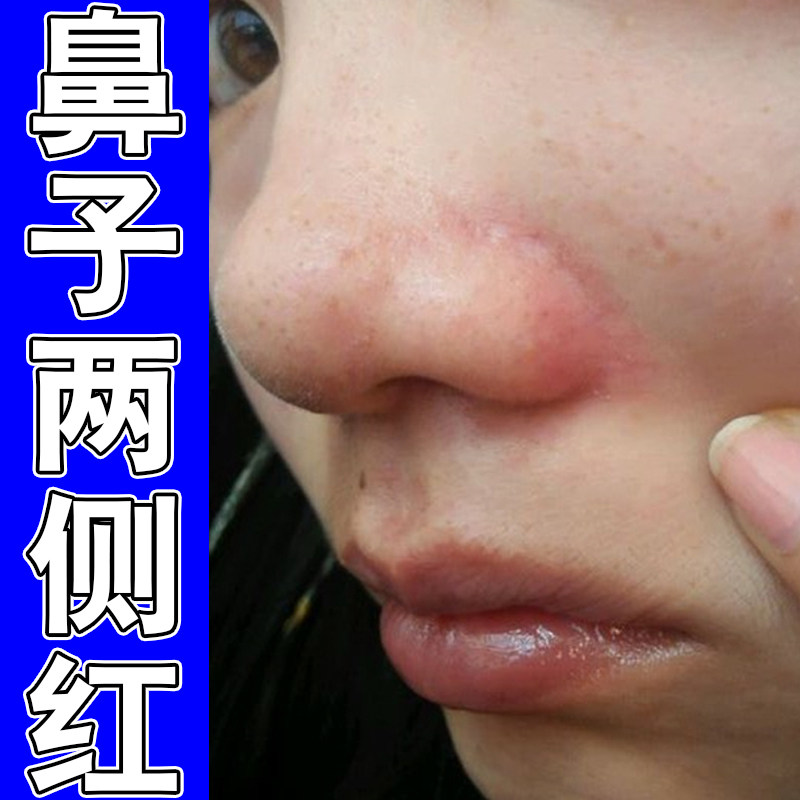 鼻子两侧红发红脱皮鼻翼两侧泛红干燥粗糙掉屑红肿过敏痒外用保湿